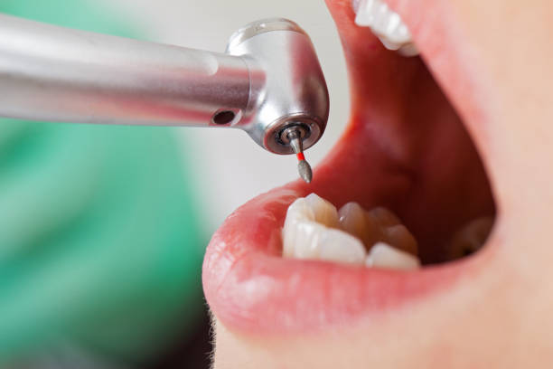 Best Emergency Root Canal Treatment in Richmond, VA